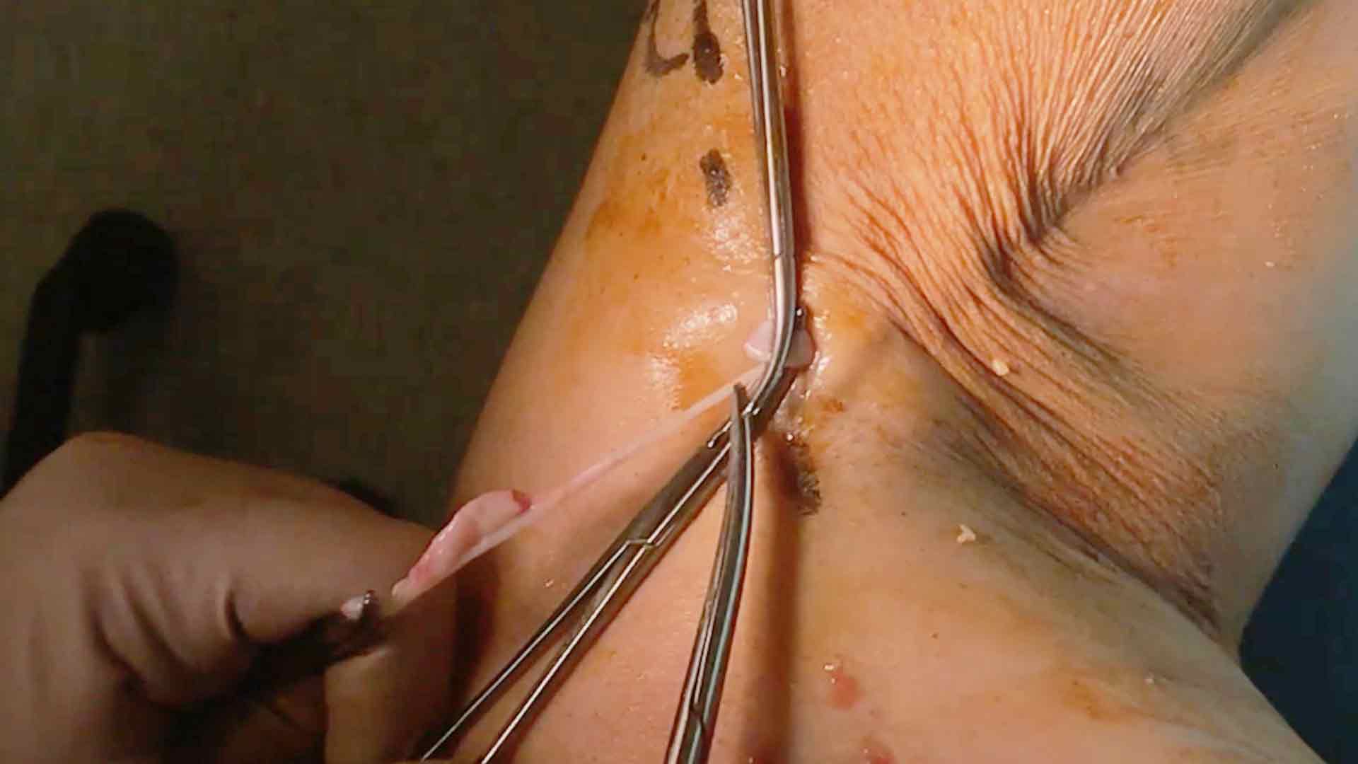 Flebectomía ténica de varices Chiva