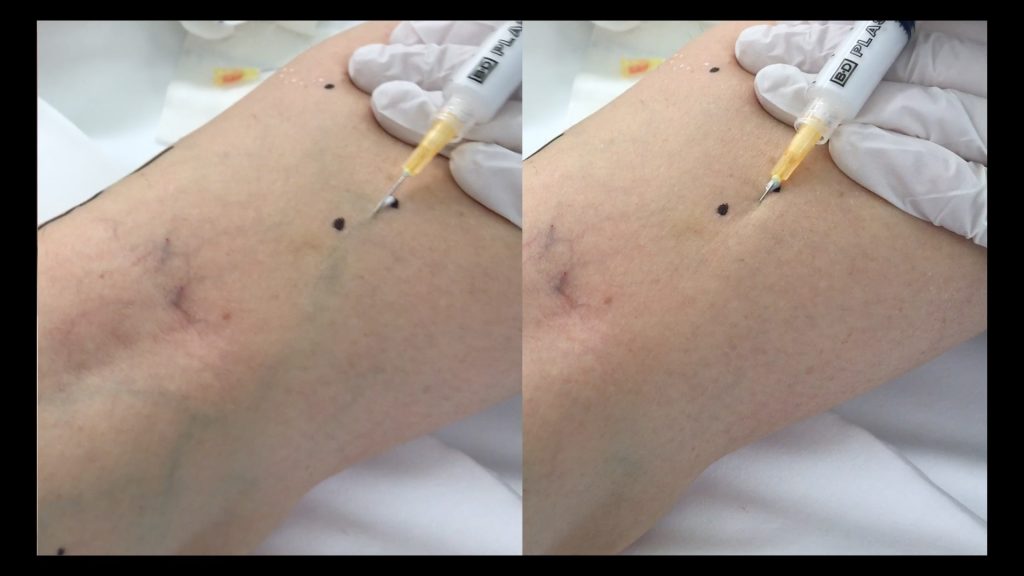 Antes y después de la inyección del esclerosante